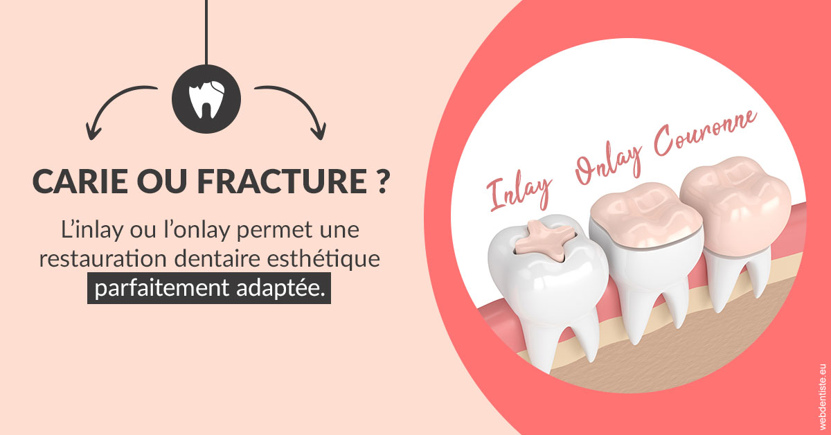 https://dr-gefflot-maxence.chirurgiens-dentistes.fr/T2 2023 - Carie ou fracture 2