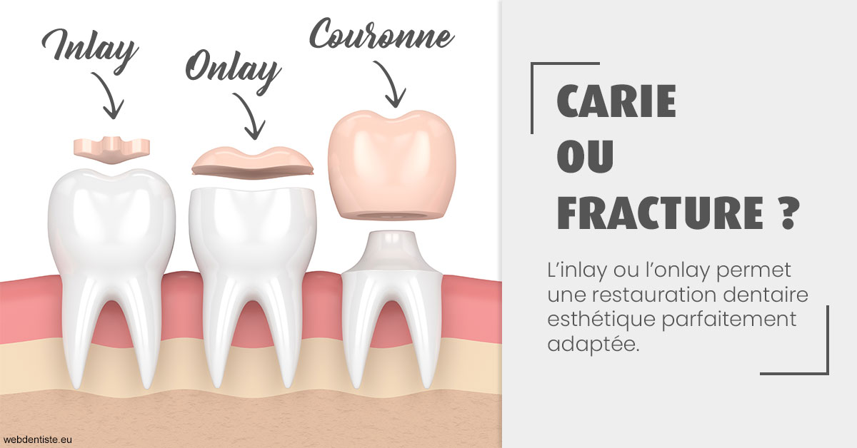 https://dr-gefflot-maxence.chirurgiens-dentistes.fr/T2 2023 - Carie ou fracture 1