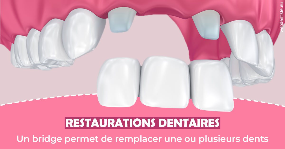 https://dr-gefflot-maxence.chirurgiens-dentistes.fr/Bridge remplacer dents 2
