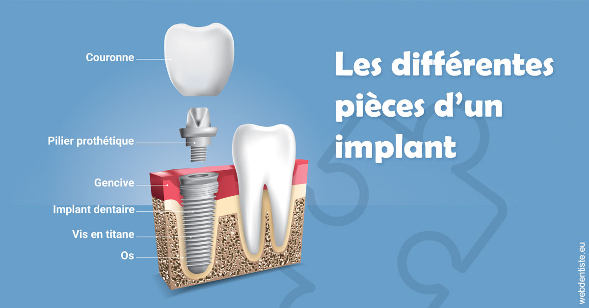 https://dr-gefflot-maxence.chirurgiens-dentistes.fr/Les différentes pièces d’un implant 1